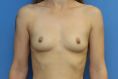 Breast Augmentation - Breast Implants - Photo before - MUDr. Jiřina Šilhánková