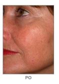 Chemical peeling - Photo before - Martin Molitor, MD, Ph.D., MBA
