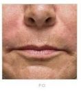 Botulinum toxin - Wrinkle Removal - Photo before - MUDr. Martin Molitor PhD.