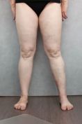 Varicose veins laser treatment - Photo before - MUDr. Jiřina Šilhánková