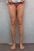 Varicose veins laser treatment - Photo before - MUDr. Jiřina Šilhánková
