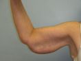 Arm Lift Surgery - Photo before - Adam J. Rubinstein M.D., FACS