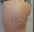 Liposuction - Photo before - Dr. med. Jozefina Skulavik
