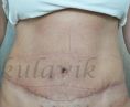 Abdominoplasty (Tummy Tucks) - Photo before - Dr. med. Jozefina Skulavik