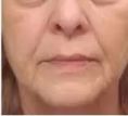 Ultherapy - Photo before - Eveclinic Bratislava