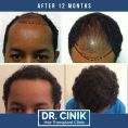 Hair Transplant - Photo before - Dr. Emrah Cinik