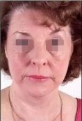 Ultherapy - Photo before - Eveclinic Bratislava