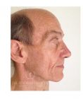 Facelift - Photo before - Dr. Albert Feichter