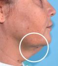 Ultherapy - Photo before - Eveclinic Bratislava