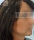 Liposuction - Photo before - MUDr. Jozef Fedeleš PhD.