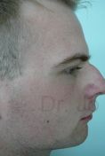 Chin Surgery - Photo before - Dr. med. Jozefina Skulavik