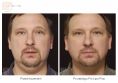 Laser Liposuction - Photo before - Dr n. med. Marcin Bieńkowski
