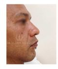 Rhinoplasty (Nose Job) - Photo before - Dr. Albert Feichter