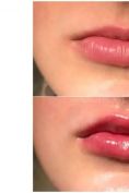 Lip augmentation - cheiloplasty - Photo before - MUDr. Diana Višňovská