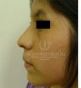 Rhinoplasty (Nose Job) - Photo before - Dr. Albert Feichter