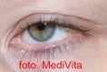 Mole removal - Photo before - lek. med. Jacek Ściborowicz - MediVita