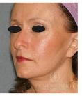 Facelift - Photo before