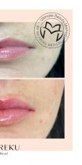 Lip augmentation - cheiloplasty - Photo before