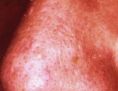 Spider veins laser removal (redness, birh marks) - Photo before - Asklepion – Laser and Aesthetic medicine