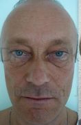 Eyelid surgery (Blepharoplasty) - Photo before - Dr. med. Jozefina Skulavik