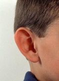 Ear surgery (Otoplasty) - Photo before