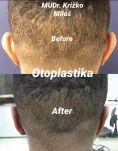 Ear surgery (Otoplasty) - Photo before - MUDr. Miloš Križko