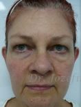 Ear surgery (Otoplasty) - Photo before - Dr. med. Jozefina Skulavik