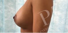 Breast Augmentation - Breast Implants - Photo before - Dr. Patrick Mallucci