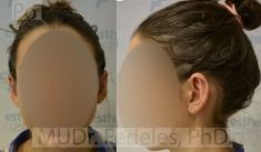 Ear surgery (Otoplasty) - Photo before