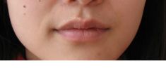 Dermal fillers - 1mL of dermal filler was carefully used to enhance this lip