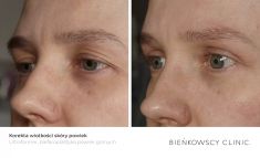 Eyelid surgery (Blepharoplasty) - Photo before - Dr n. med. Marcin Bieńkowski