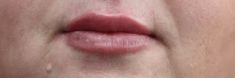 Dermal fillers - Photo before - MUDr. Jiřina Šilhánková