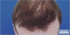 Hair Transplant - Photo before - MUDr. Jozef Hedera