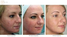 Laser acne treatment - Photo before - Dr Ilona Wnuk-Bieńkowska