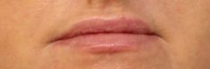 Dermal fillers - Photo before - MUDr. Jiřina Šilhánková