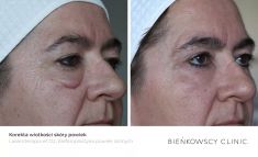 Eyelid surgery (Blepharoplasty) - Photo before - Dr n. med. Marcin Bieńkowski