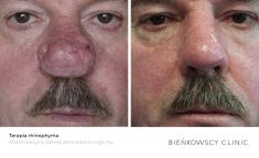 Mole removal - Photo before - Dr n. med. Marcin Bieńkowski