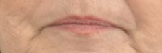 Dermal fillers - Photo before - MUDr. Jiřina Šilhánková