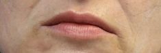 Dermal fillers - Photo before - MUDr. Jiřina Šilhánková