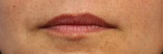 Dermal fillers - Photo before - MUDr. Jiřina Šilhánková