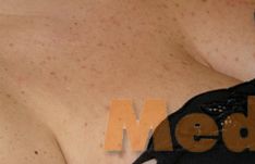 Tattoo removal - Photo before - lek. med. Jacek Ściborowicz - MediVita