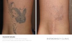 Tattoo removal - Photo before - Dr n. med. Marcin Bieńkowski