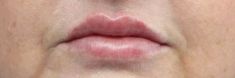 Dermal fillers - Photo before - MUDr. Jiřina Šilhánková