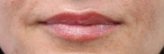 Dermal fillers - Photo before - MUDr. Jiřina Šilhánková