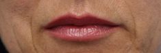 Dermal fillers - Photo before - MUDr. Jiřina Šilhánková