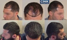 Hair Transplant - FUE - Method: 
For those who want to have a hair transplant, the burning question is which hair transplantation procedure is the best technique. The FUE technique, which refers to “Follicular Unit Extraction” or “Individual Follicle Extraction”, is considered the most advanced hair transplant technique available.

The FUE hair transplant technique is surgical variant of the follicular micro transplant technique and it is implemented by extracting the follicles of the donor site on an individual basis without the need of stitches and without leaving scars.

These follicular units in groups of 1, 2, 3 or 4 hair groups are extracted in its natural groupings and prepared carefully. As a matter of principle, there is no better technique than another since the form of extraction the follicles from the donor zone by keeping its natural form.