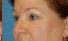 Brow lift - Photo before - Martin Molitor, MD, Ph.D., MBA