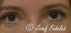 Eyelid surgery (Blepharoplasty) - Photo before - MUDr. Jozef Fedeleš PhD.