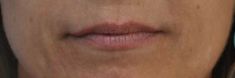Dermal fillers - Photo before - MUDr. Jiřina Šilhánková