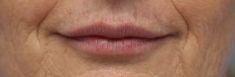 Dermal fillers - Photo before - MUDr. Jiřina Šilhánková